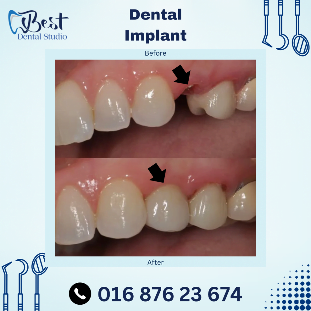 Dental Implant