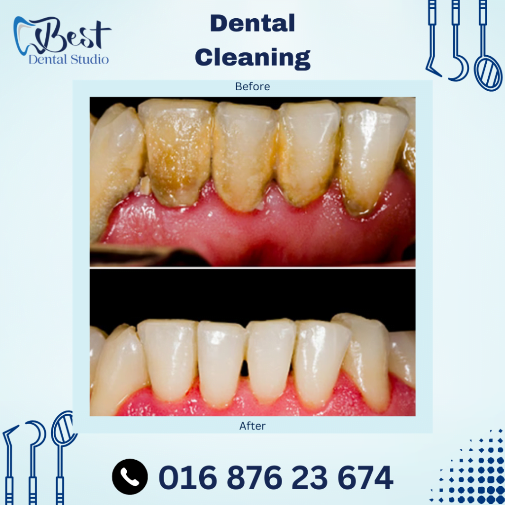 Dental Cleaning