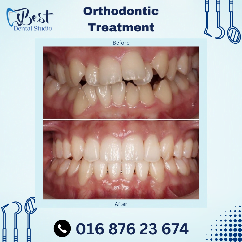 Orthodontic Treatment