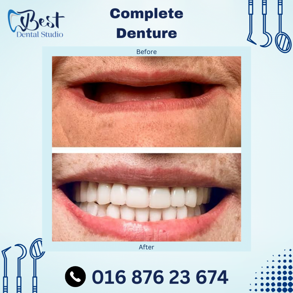 Complete Denture