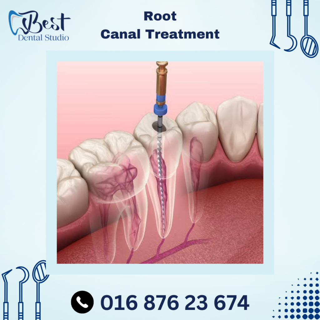 Root Canel Treatment