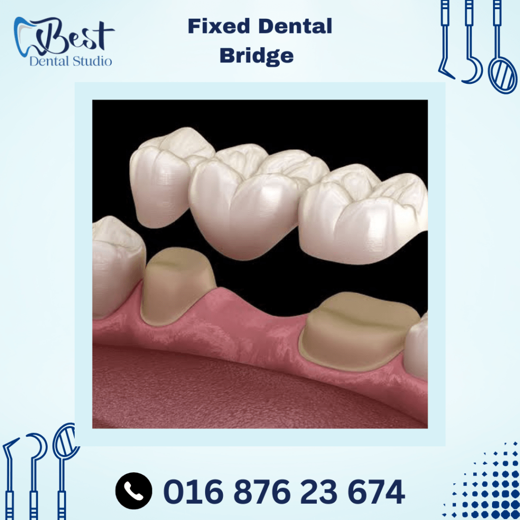 Fixed Dental Bridges (Crown)