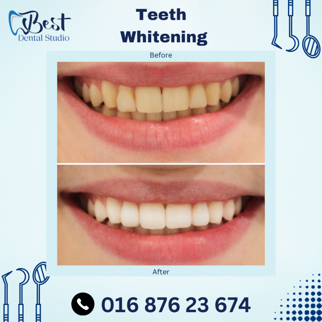 Teeth Whitening