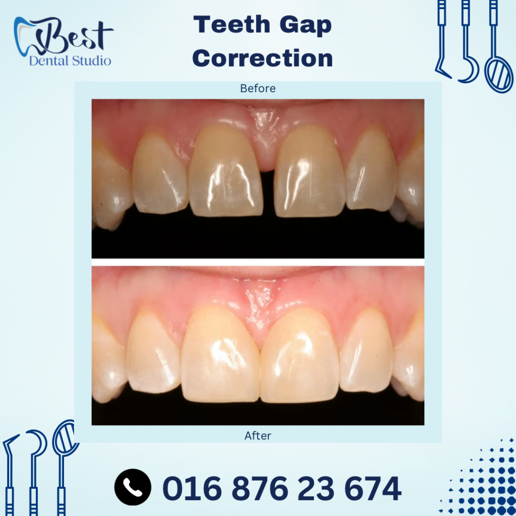 Teeth Gap Correction