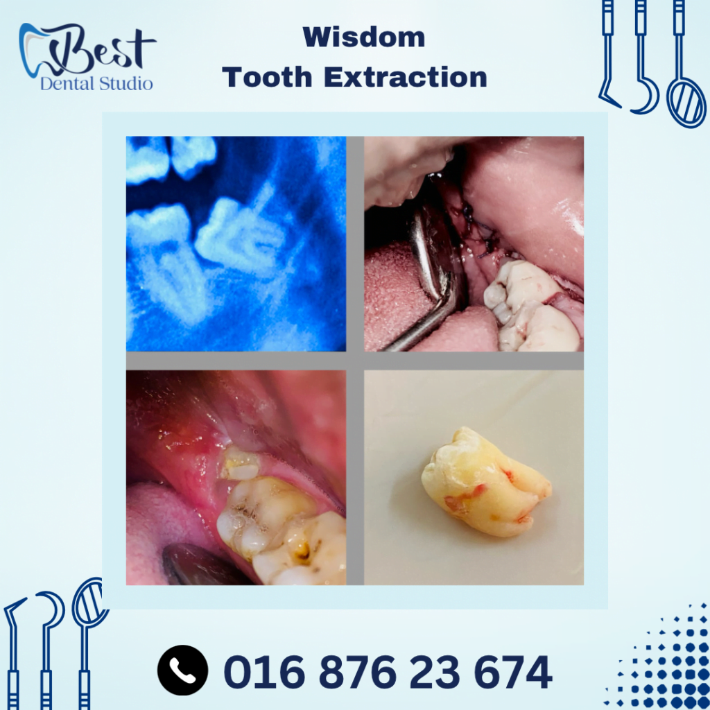 Wisdom Tooth Extraction