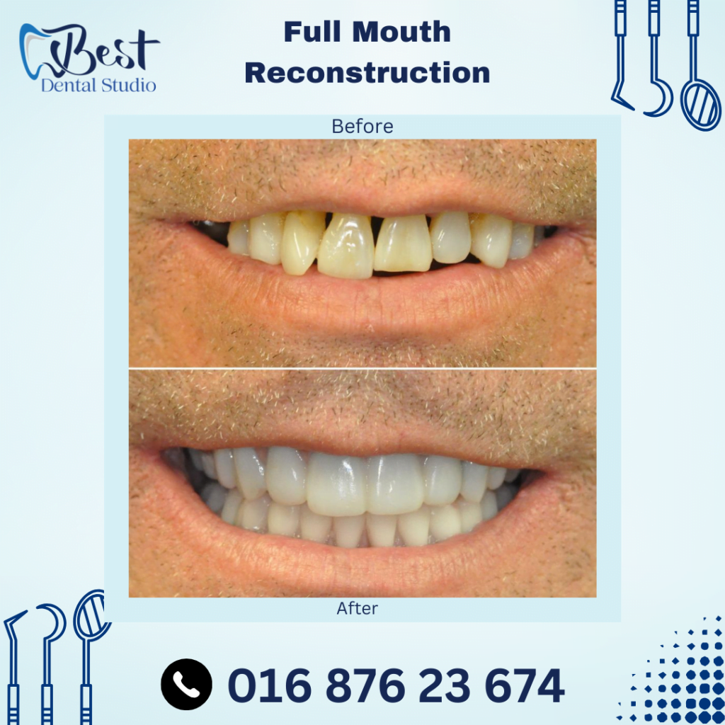 Full Mouth Reconstruction