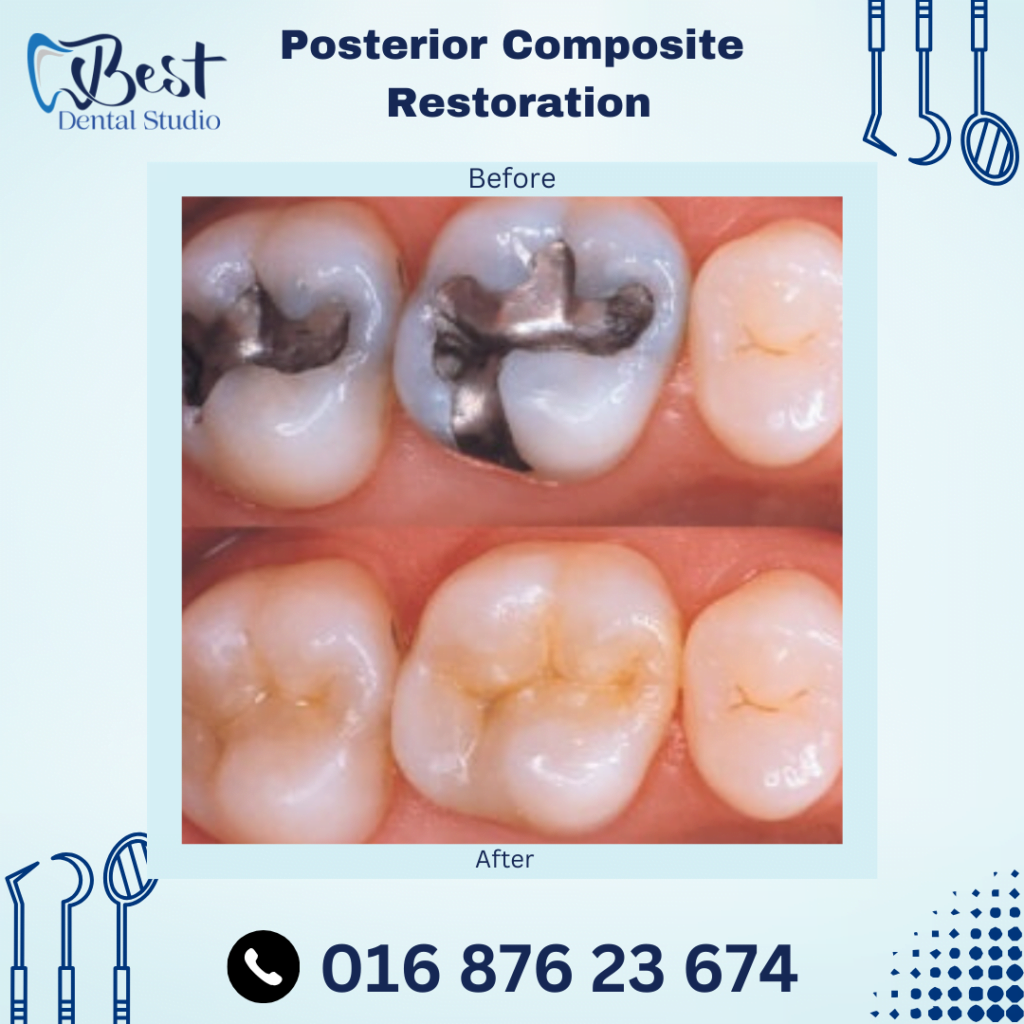 Posterior Composite Restoration