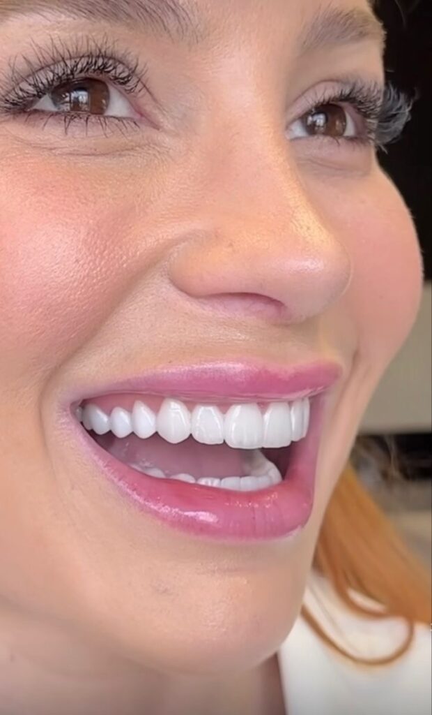 Teeth Whitening