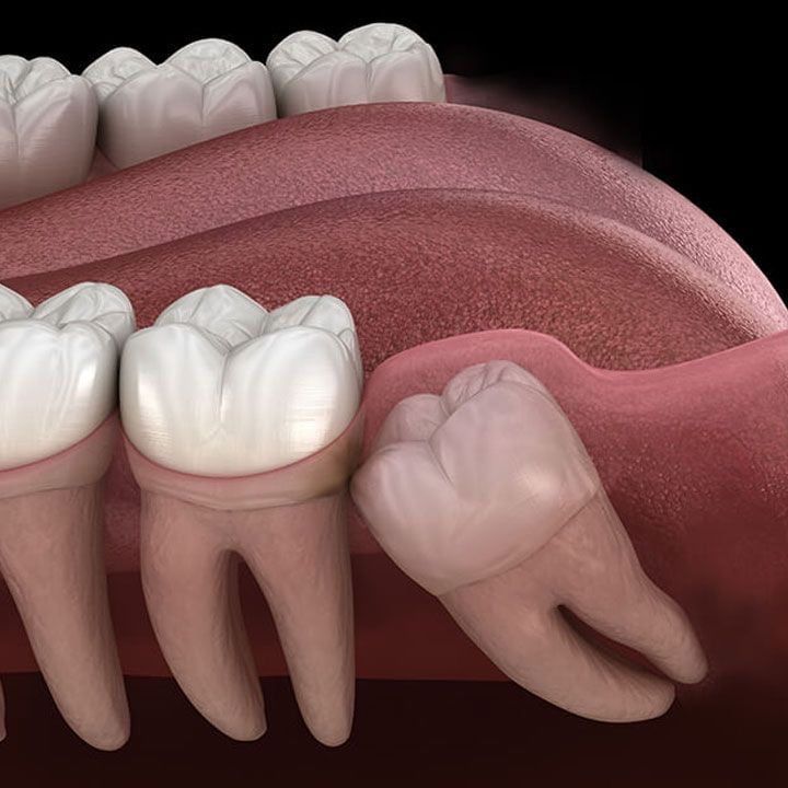 Extraction Of wisdom Teeth 1