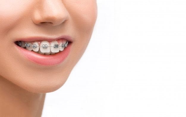 Orthodontic Treatment Braces 2