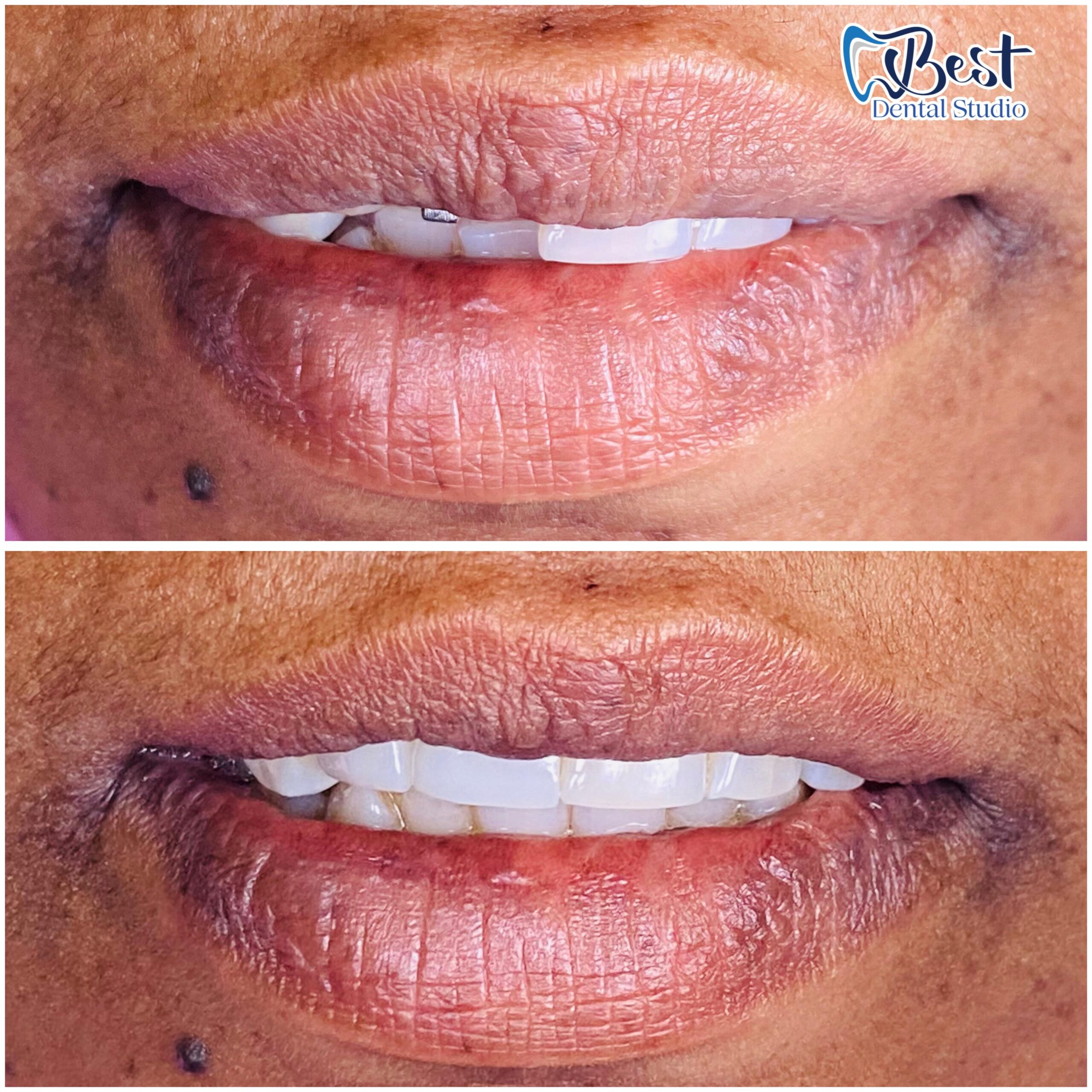 Teeth Gap Treathment (1)