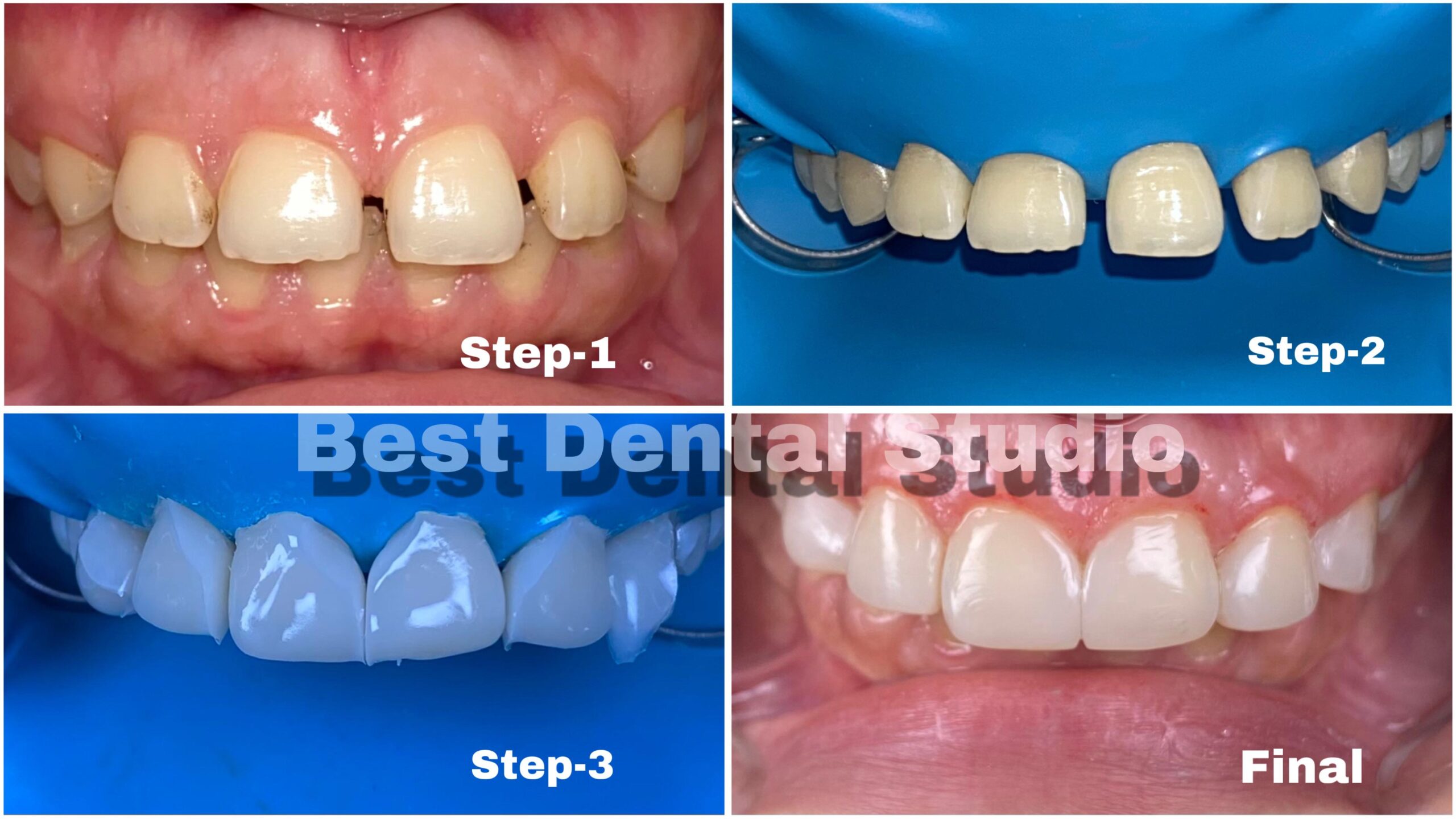 Teeth Gap Treathment (10)