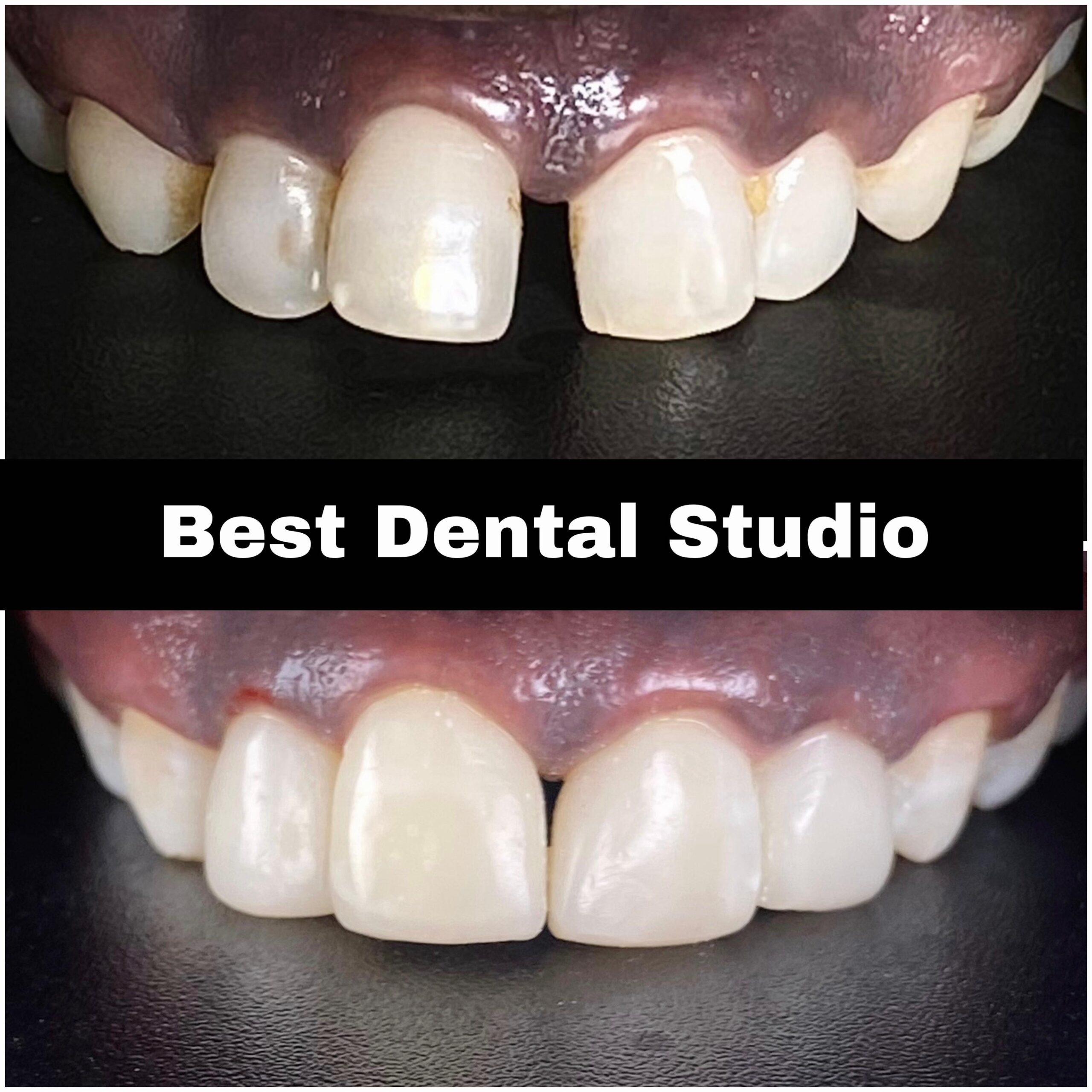 Teeth Gap Treathment (11)