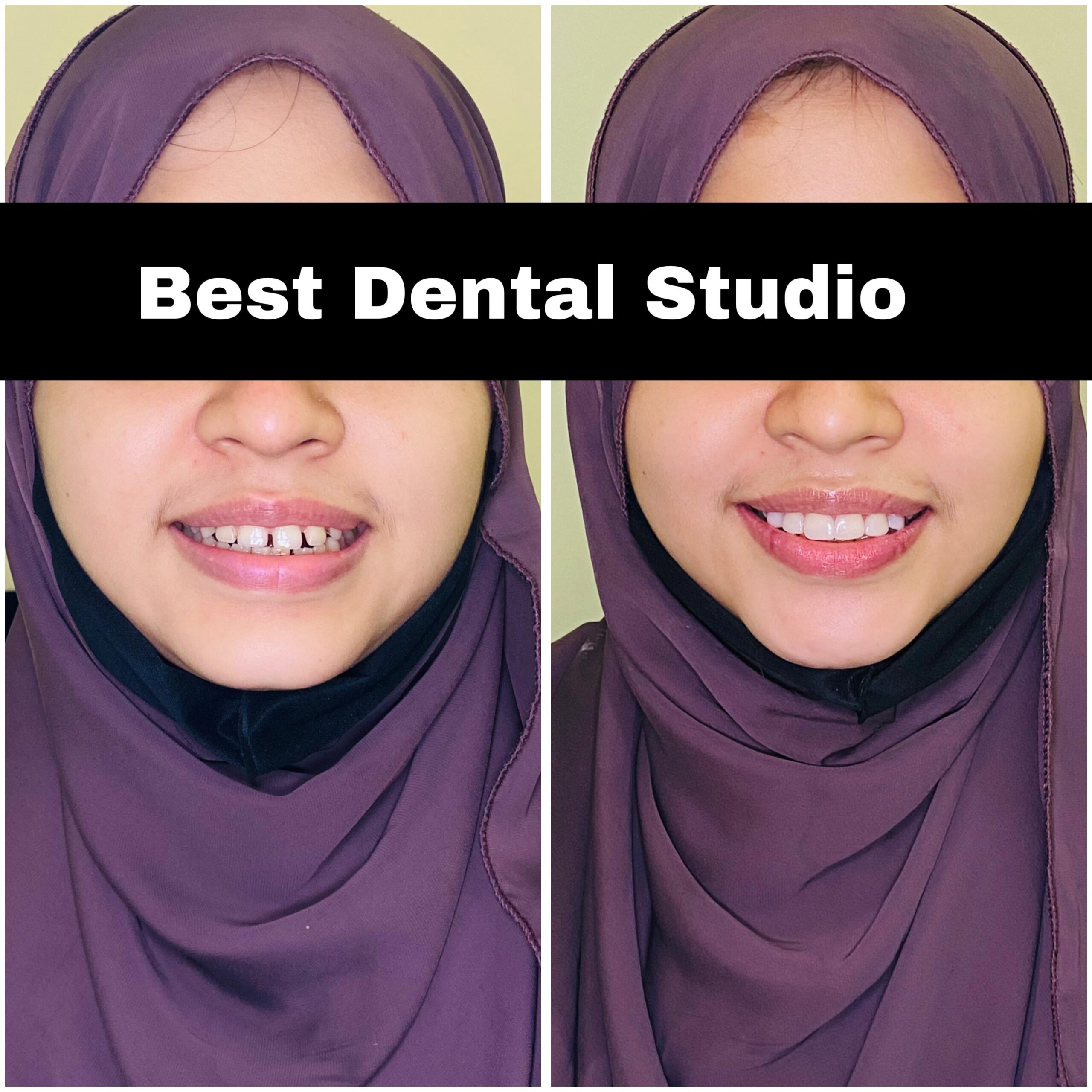 Teeth Gap Treathment (12)