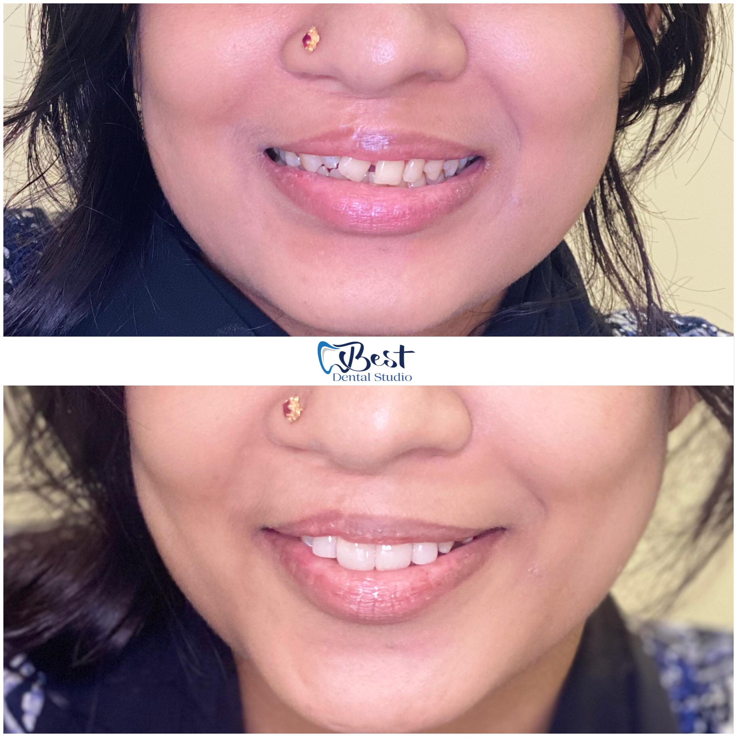 Teeth Gap Treathment (13)