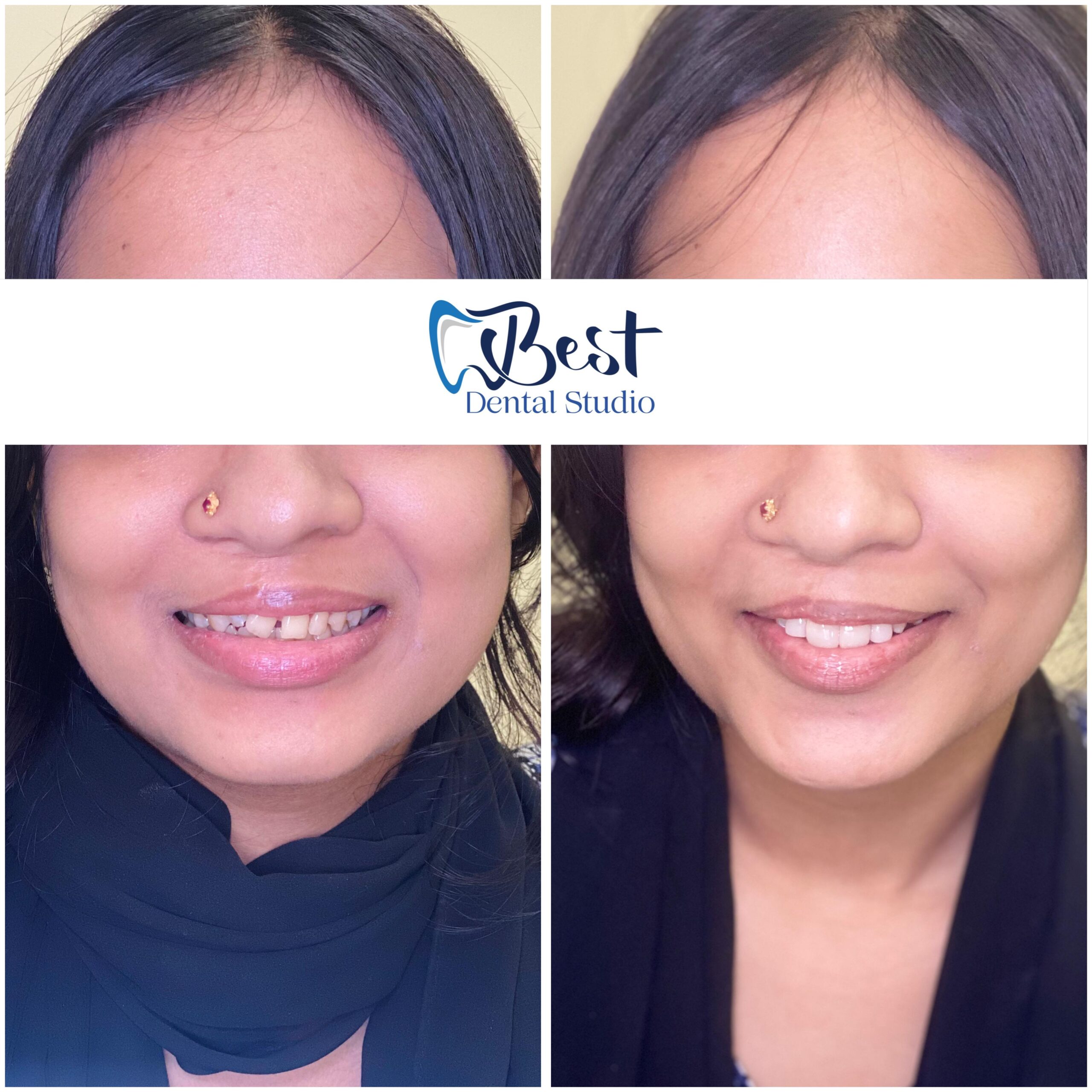 Teeth Gap Treathment (14)