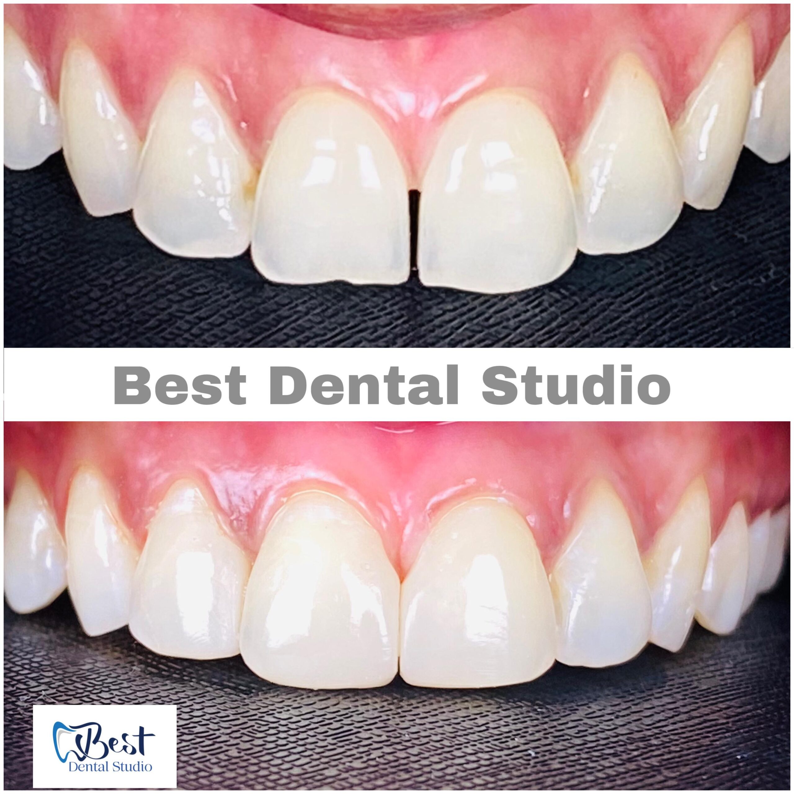 Teeth Gap Treathment (15)