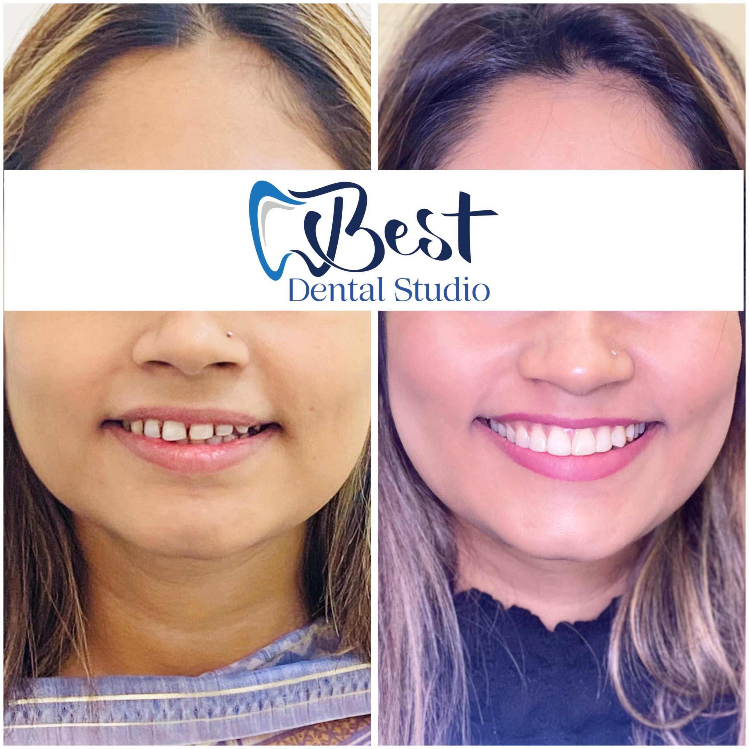 Teeth Gap Treathment (16)