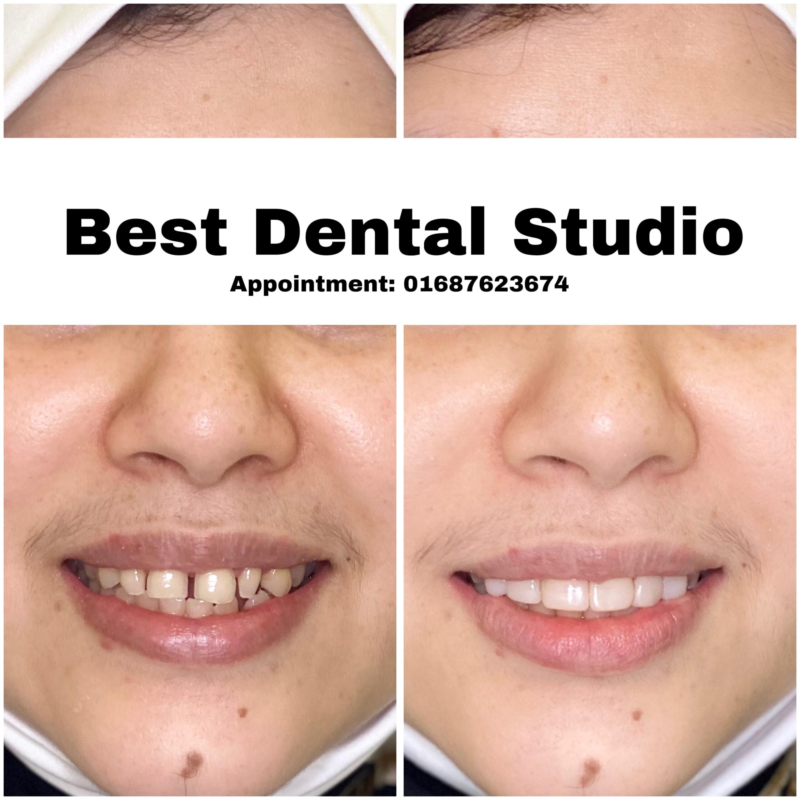 Teeth Gap Treathment (17)