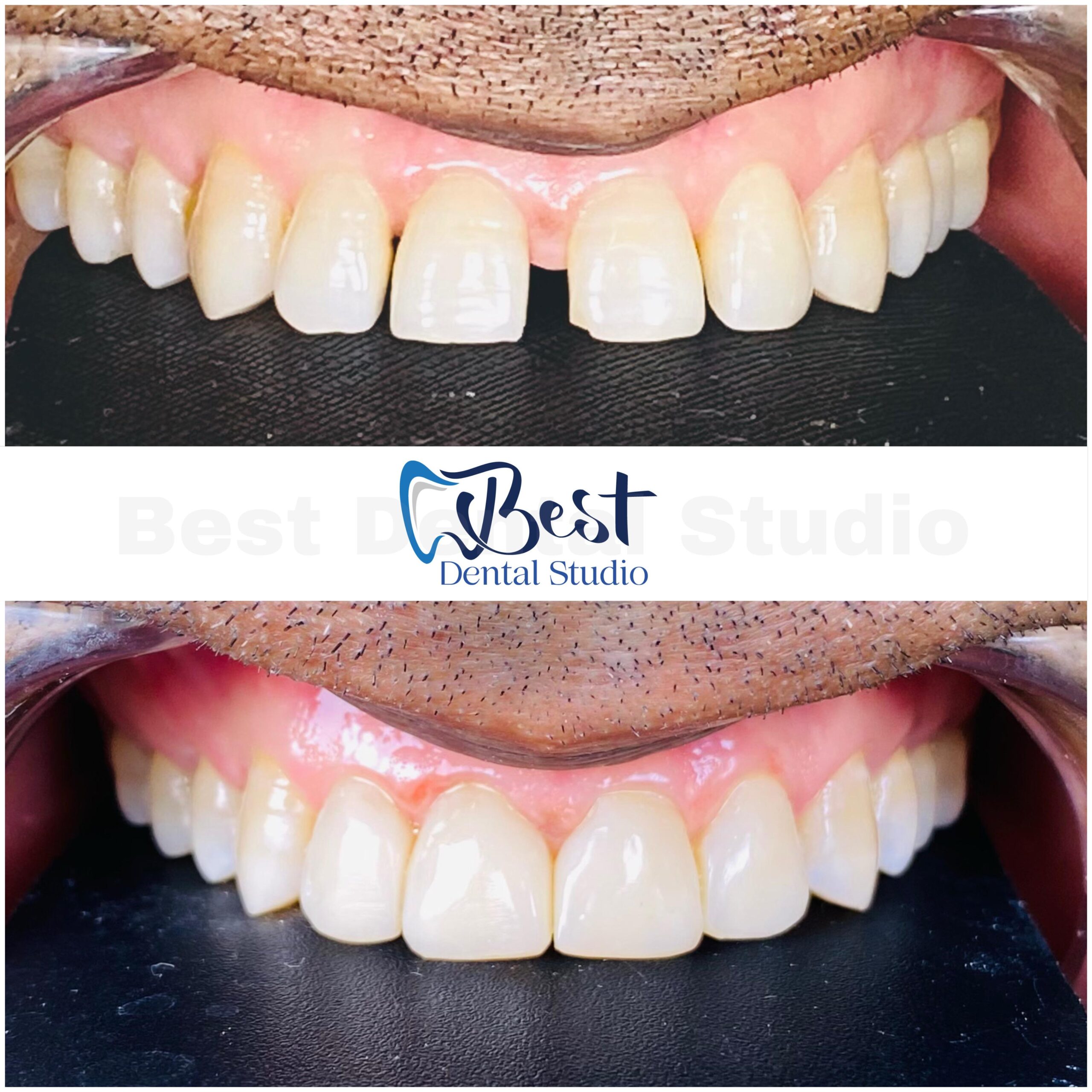 Teeth Gap Treathment (18)