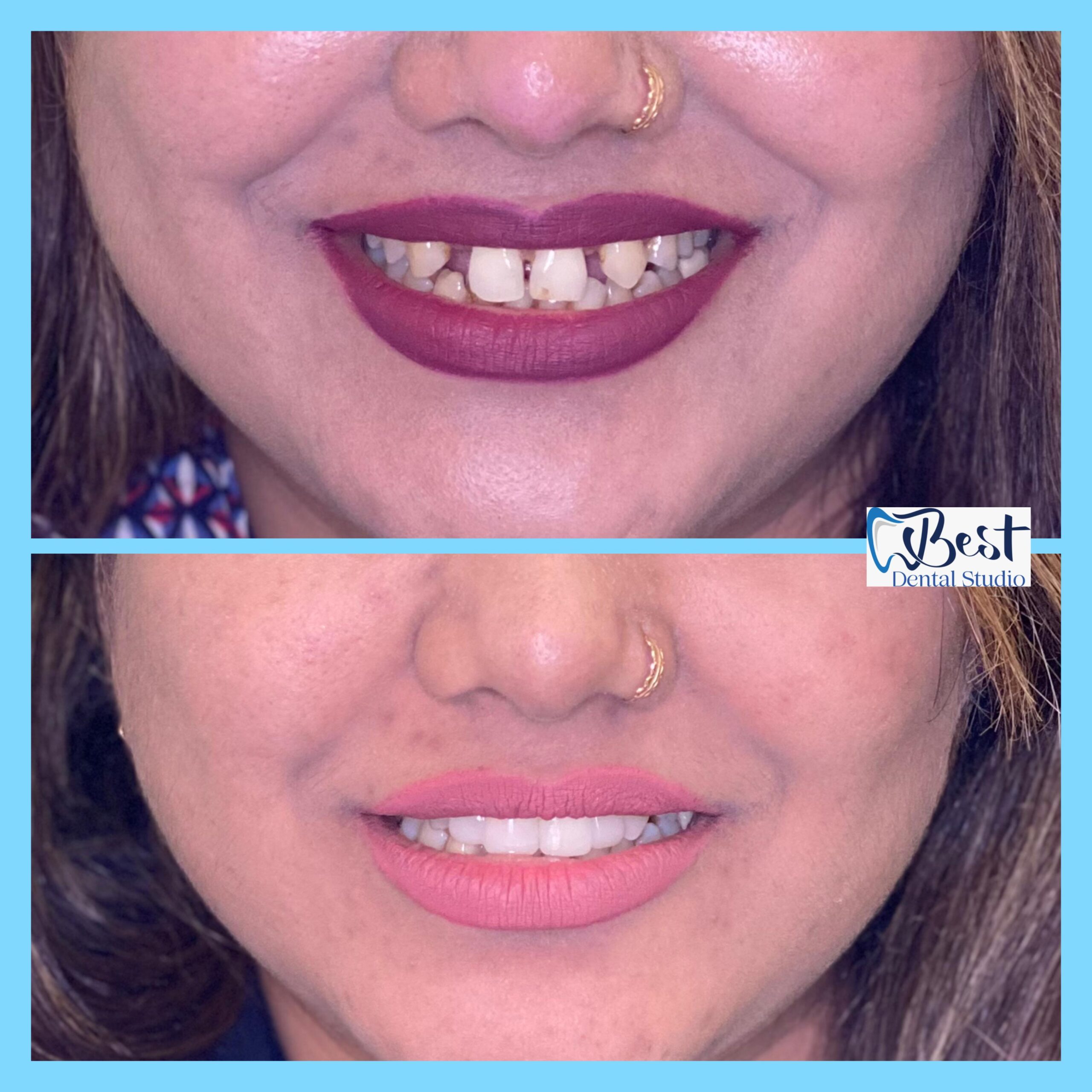 Teeth Gap Treathment (19)