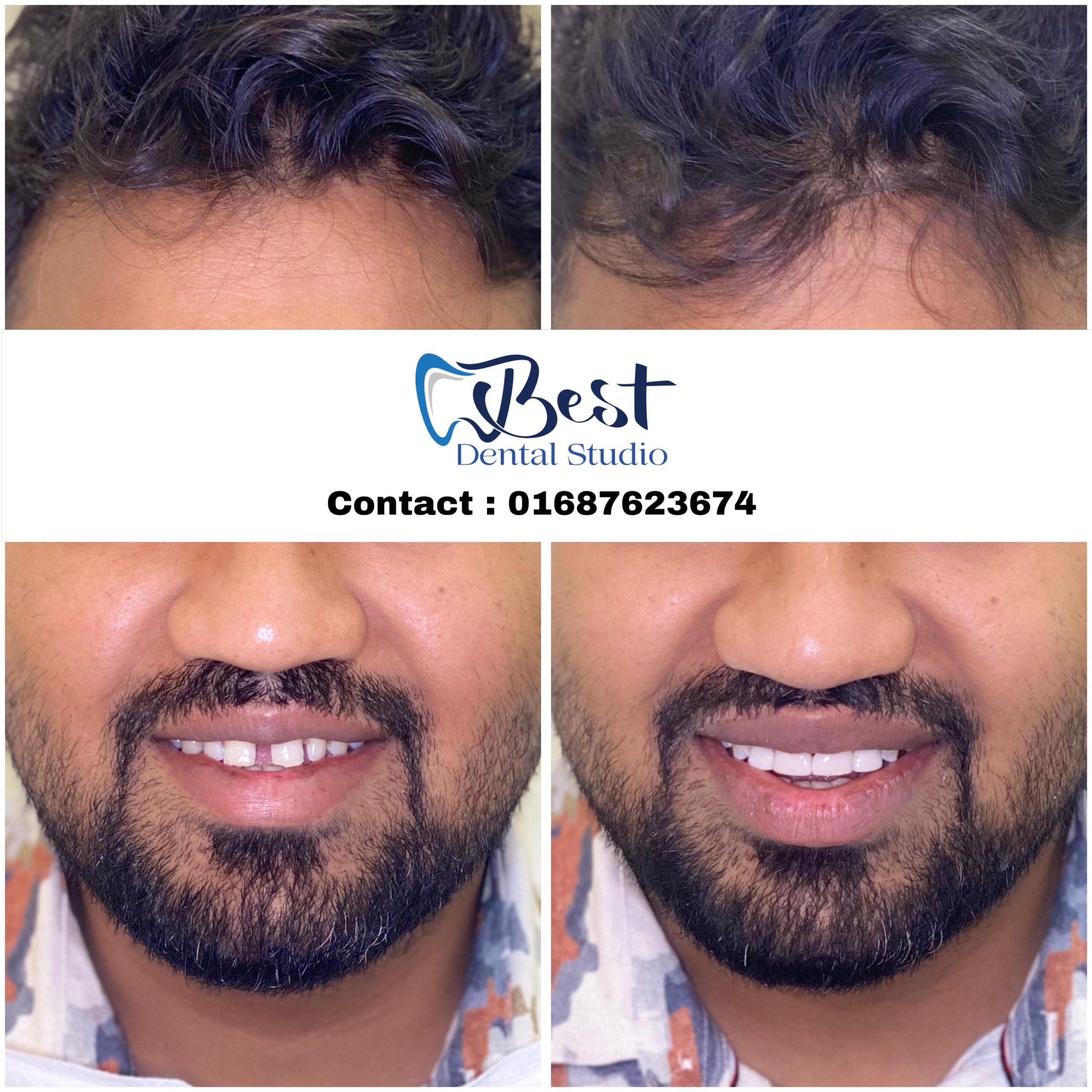 Teeth Gap Treathment (2)