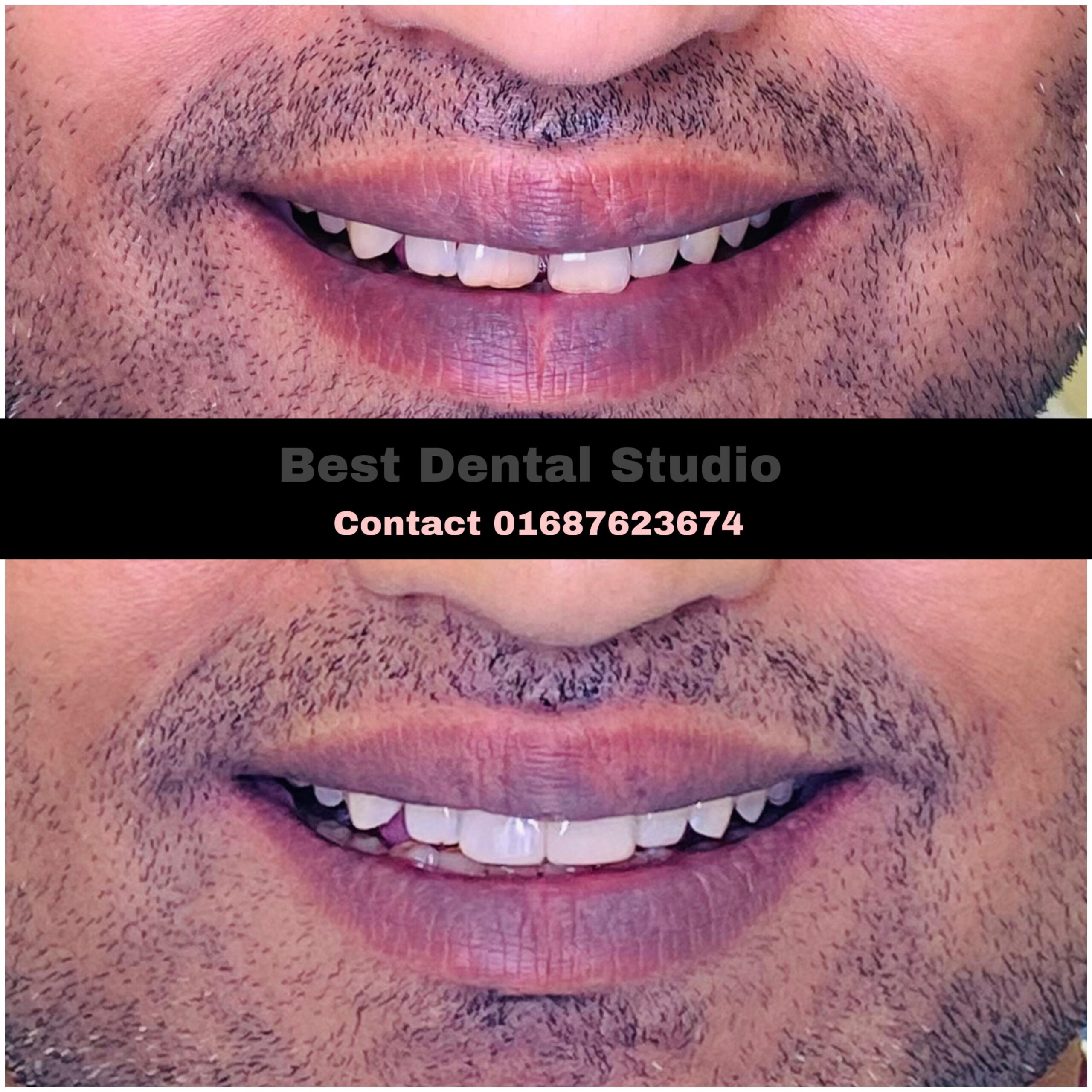 Teeth Gap Treathment (20)