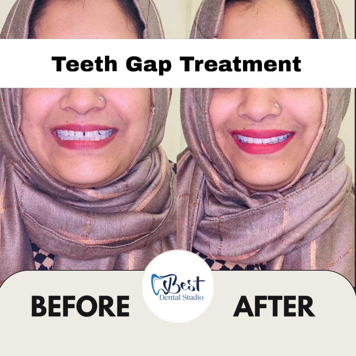 Teeth Gap Treathment (3)