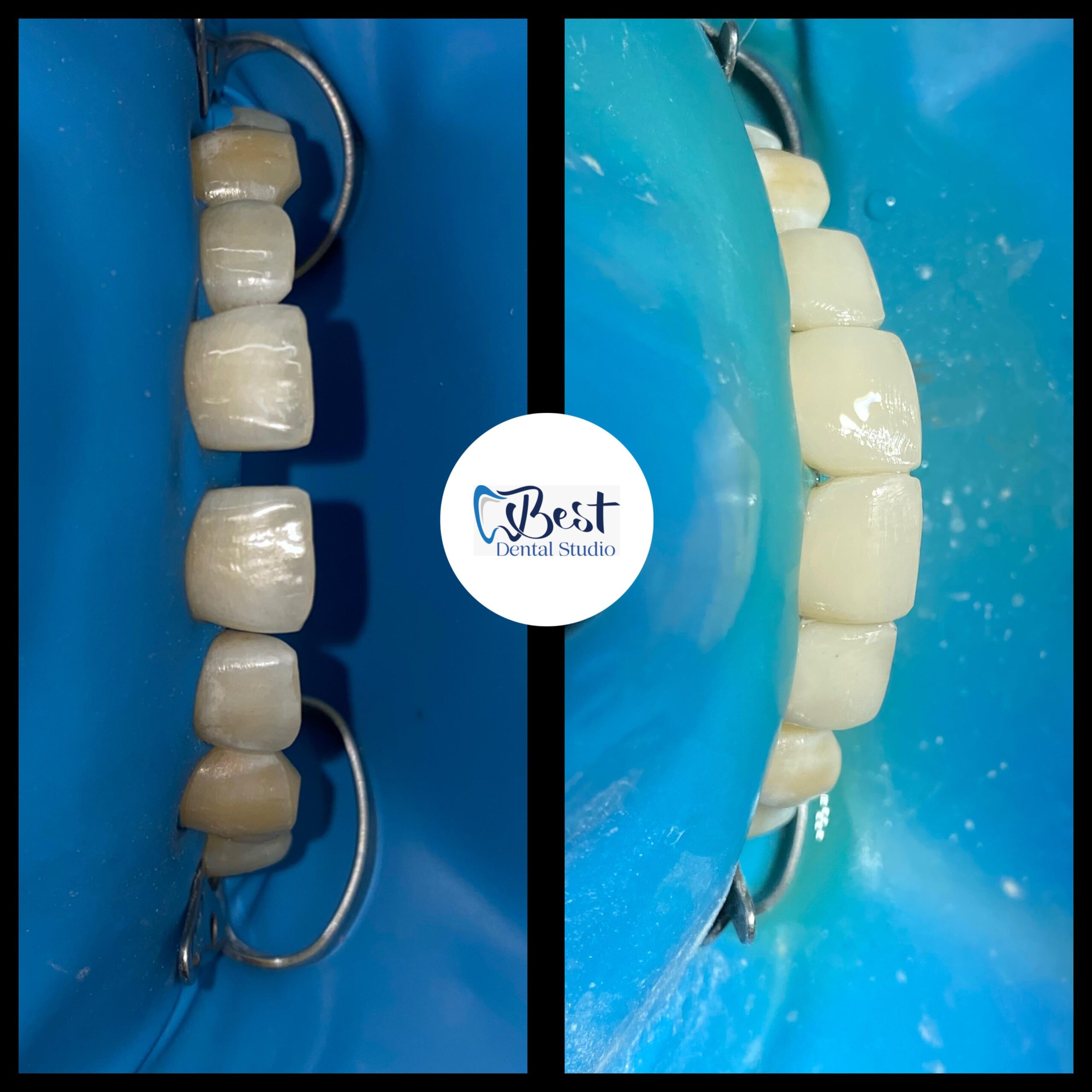 Teeth Gap Treathment (4)