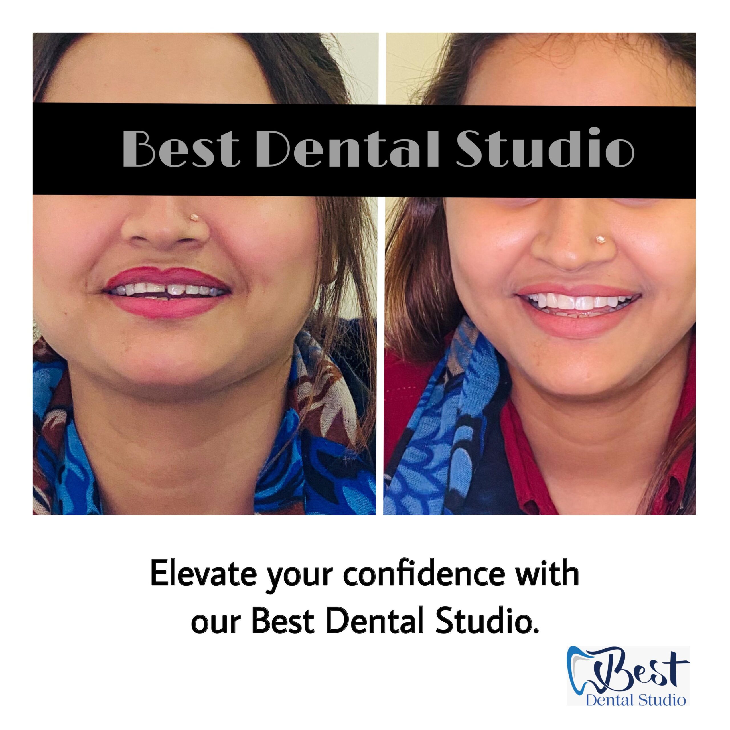 Teeth Gap Treathment (6)