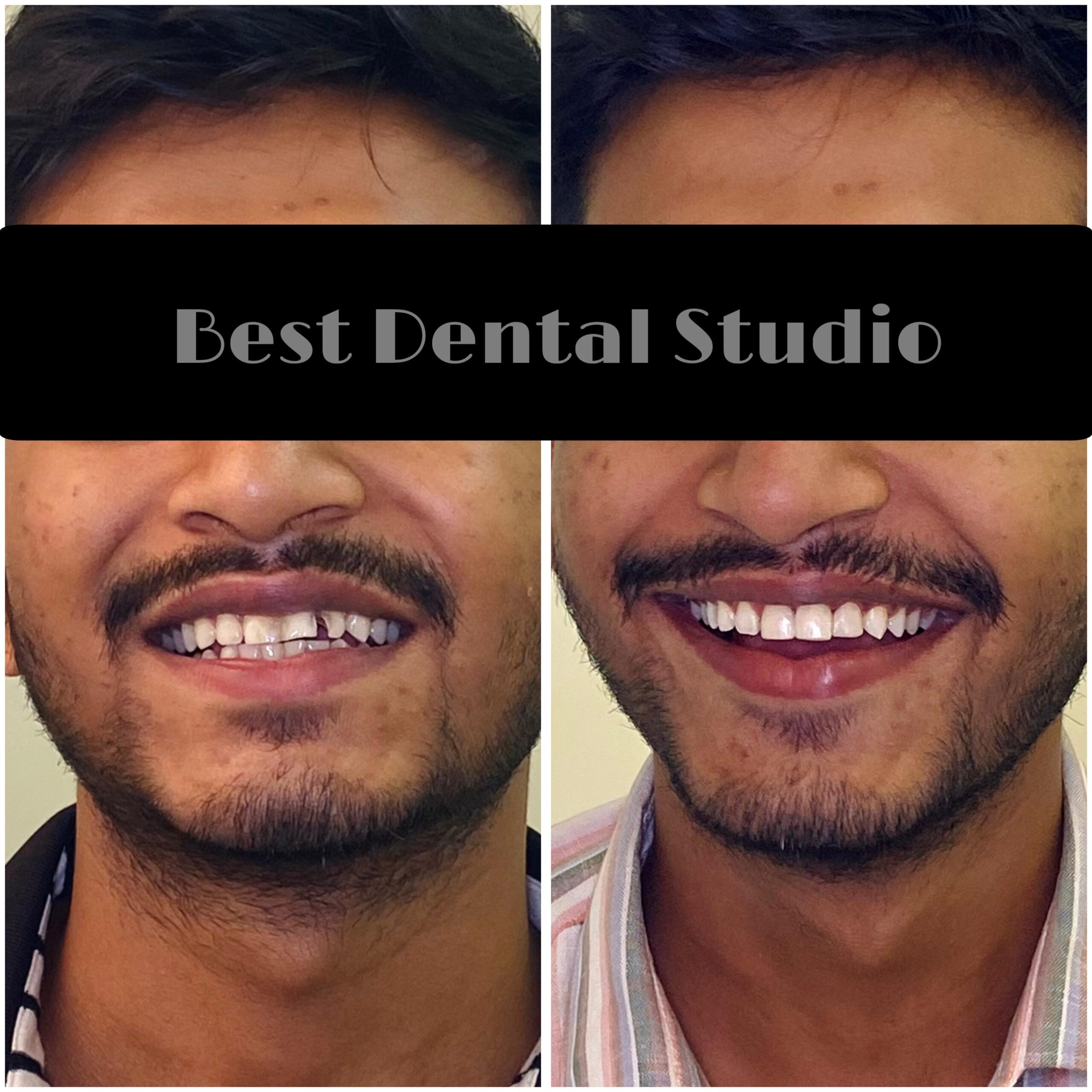 Teeth Gap Treathment (7)