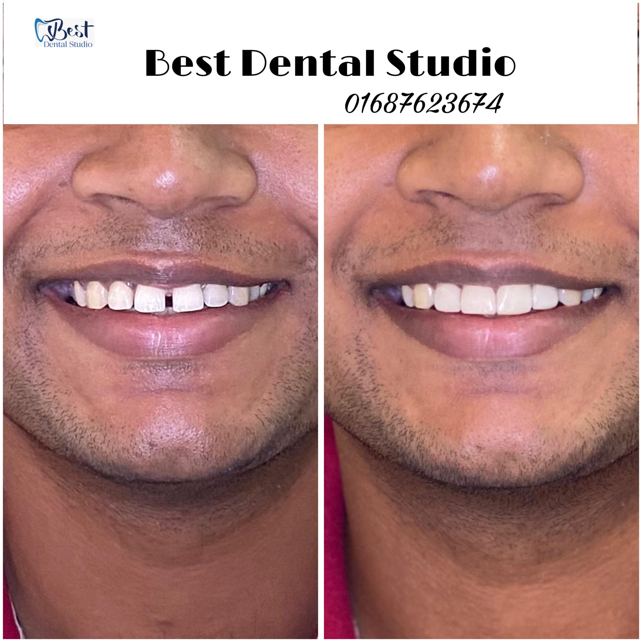 Teeth Gap Treathment (8)