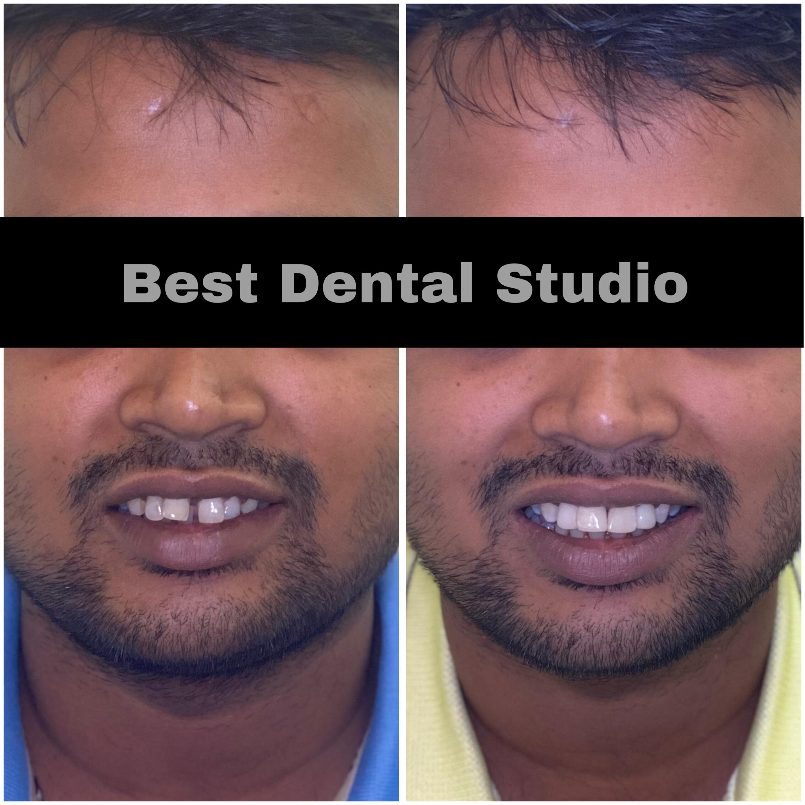 Teeth Gap Treathment (9)